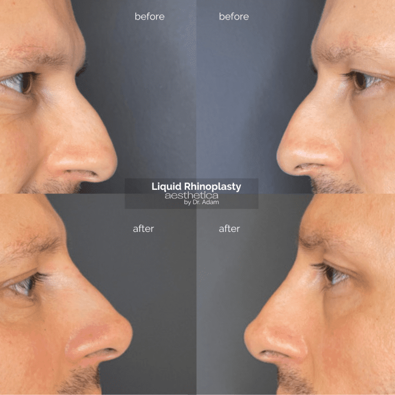 The Impact of Aesthetica’s Non-Surgical Face Fillers
